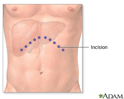 Liver Transplant - Series