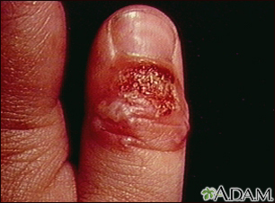 Intelligible message herpetic whitlow on bottom of foot Right! herpetic whitlow on bottom of foot