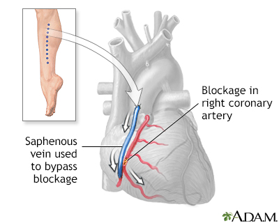 Heart Bypass Surgery - Series