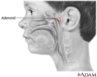 Adenoid removal