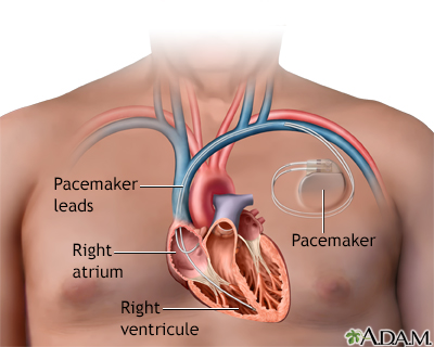 sick sinus syndrome covid vaccine