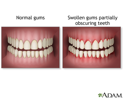 gums swollen disease periodontal mouth stomatitis protruding causes herpetic bulging infection enlarged definition slideshow