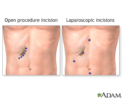 Gallbladder removal - series