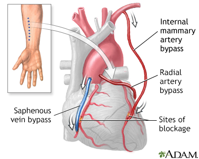 Heart bypass surgery - series